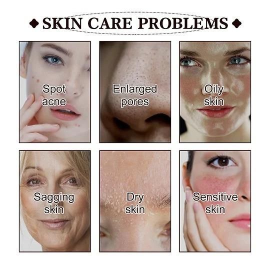 Black Tea Face Mask 100g - Anti-Acne & Dark Spot Treatment Mask for Clear, Glowing Skin